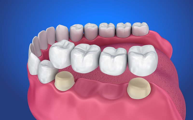 dental bridges
