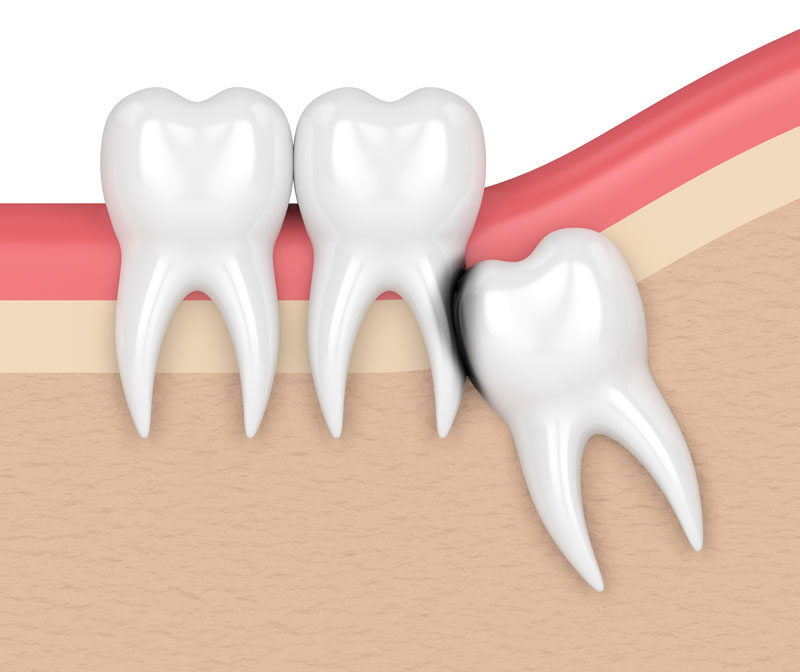 wisdom teeth extraction